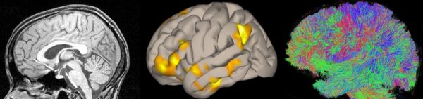 Neuroanatomy refresher : Language and the Brain